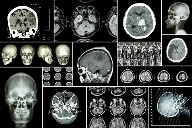 Tumor na mozgu