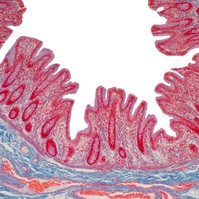Mikroszkópos colitis: ilyen tünetekkel jár a gyulladásos bélbetegségek (IBD) harmadik típusa