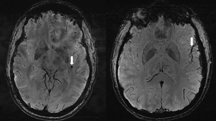 Zidentyfikowano zmiany w mózgach osób cierpiących na migreny. Nadzieja na nowe terapie, fot. Radiological Society of North America/ Wilson Xu