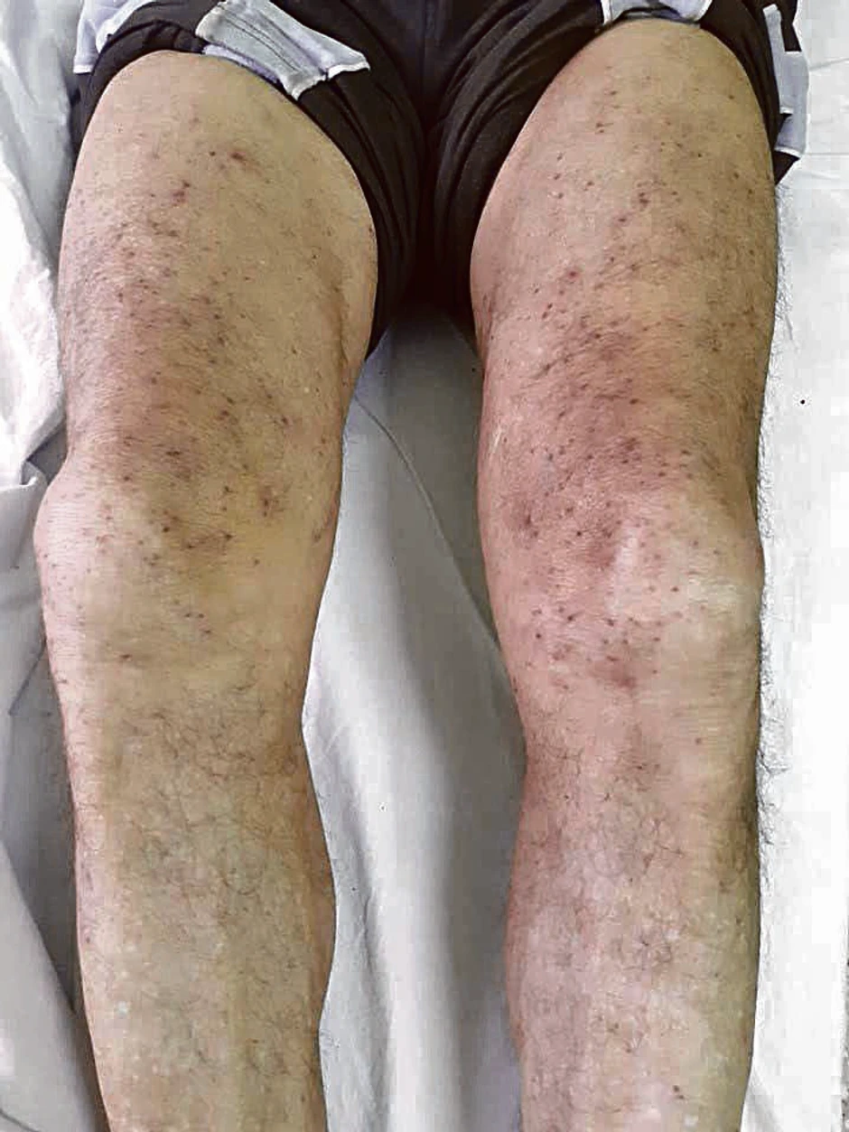 Miladin Maksimović imao je na obe noge po 100 ujeda, a u ambulanti su mu iz vrata izvadili 40 žaoka