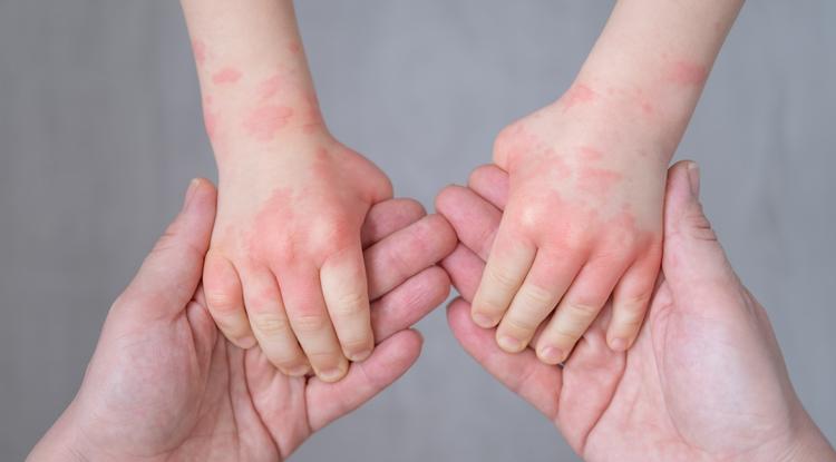 Az ekcéma a világ leggyakoribb bőrbetegsége, Fotó: Getty Images