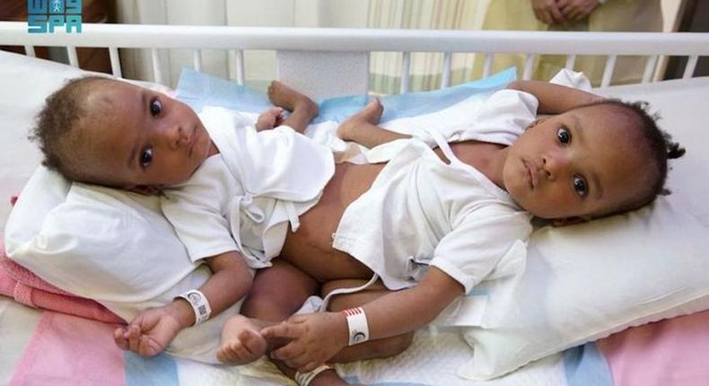 The Nigerian conjoined twins, Hassana and Hussaina are currently in a separation surgery [Arab News]