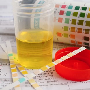 Mit jelez a magas vizelet fajsúly?Ártalmatlan jel vagy komoly figyelmeztetés?