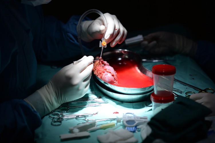 Przeszczep krzyżowy nerek. Pierwszy taki w Polsce