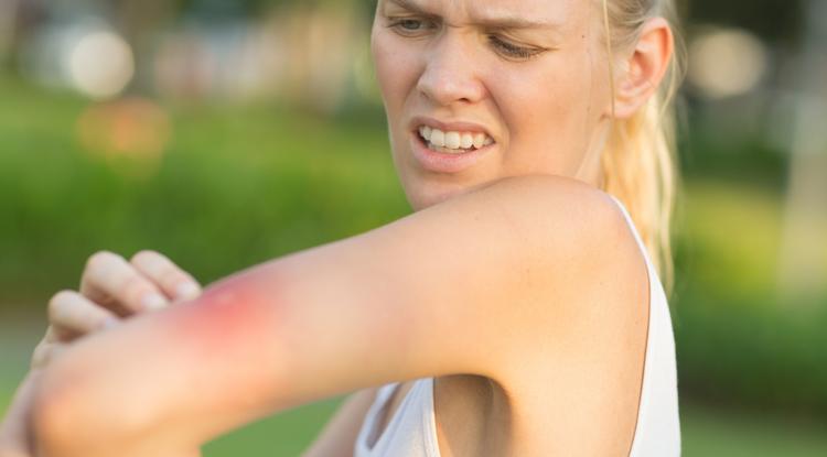 Azonnal hívj mentőt, ha ezt tapasztalod Ezek a darázscsípés allergia tünetei Fotó: Getty Images