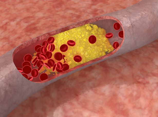 Hipercholesterolemia rodzinna to tykająca bomba. Jak ją wykryć?