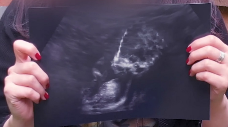 Mary ultrahangos bizonyítékkal is alátámasztja történetét /Fotó: Youtube