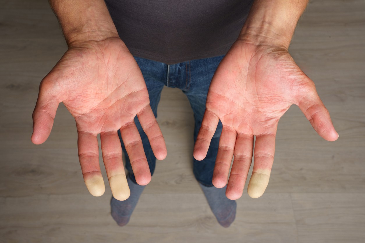 Raynaudova choroba môže súvisieť s pocitom chladu. (ilustračné foto)