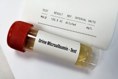 Mit jelent a vizelet mikroalbumin érték a laborleleten?