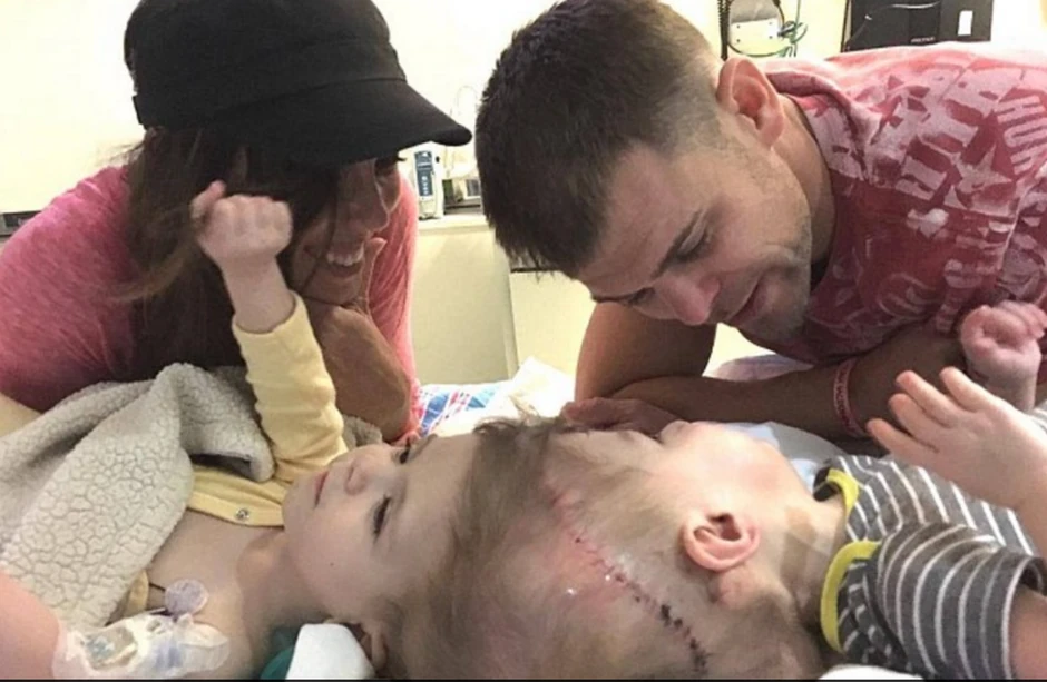 Blizanci dok su bili spojeni