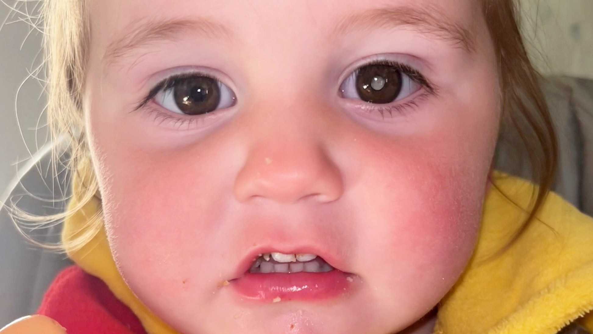 Dievčatku diagnostikovali retinoblastóm v pokročilom štádiu.