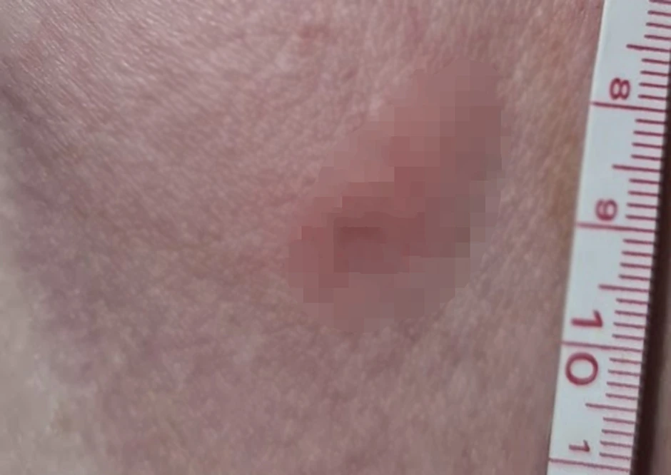 Otok i crvenilo mogu biti i preko 10 mm