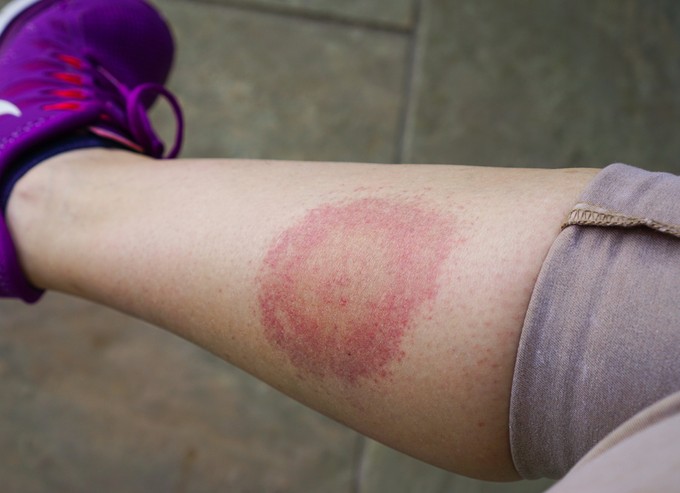 Áttörés a Lyme-kór diagnosztikájában: így csípik el a kórokozót