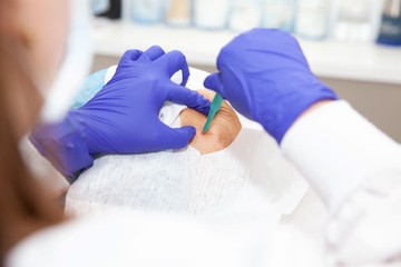 Ekkor lehet szükség bőrbiopsziára: nem csak rákgyanú esetén végzik című cikk nyitóképe