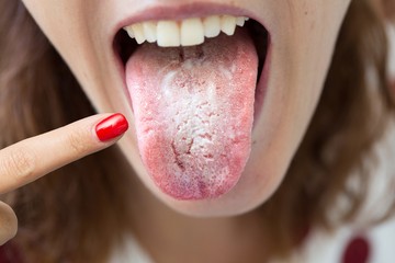 szájpenész, candida, gmba, fertőzés, természetes módszerek, terápia