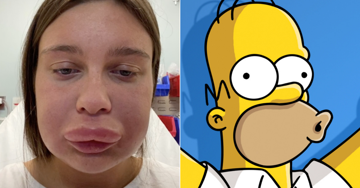 Žena po skrášľovacej procedúre vyzerala ako Homer Simpson.