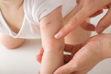 Mi okozhat kiütéseket a csecsemő bőrén? Ezek állhatnak a háttérben