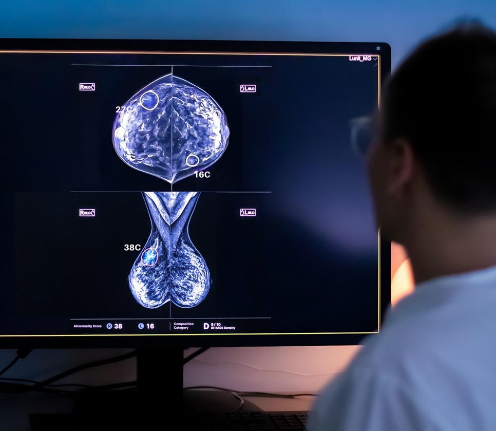 Mesterséges Intelligencia az emlődiagnosztikában.