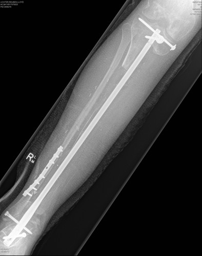 ODTWORZYLI KOŚĆ DZIĘKI DRUKARCE 3D