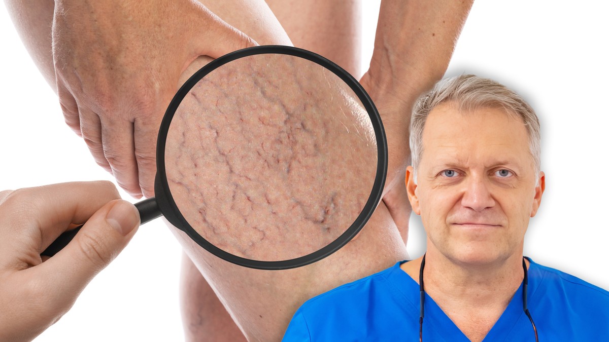 Ljudi očekuju da prvo vide velike plave vene, međutim, često sve počinje mnogo diskretnije, objašnjava vaskularni hirurg dr Dario Jocić