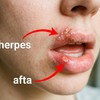 Herpes i afta, ilustracija kreirana uz pomoć AI.