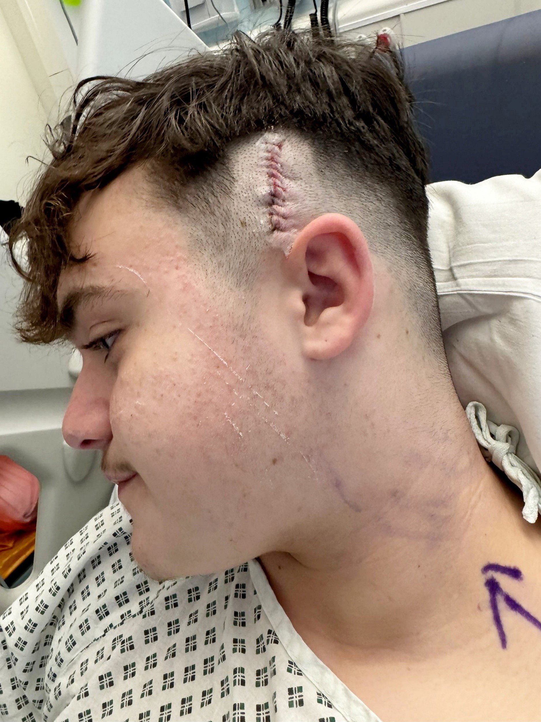 Maxovi objavili neoperovateľný nádor.