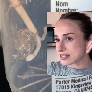 „Rémisztő” szőrgombócot távolítottak el egy nő hüvelyéből - Ez tekeredett a spirálja köré