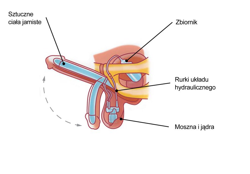 zaburzenia erekcji 