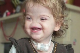 Devojčica rođena bez nosa PROŠLA JE KROZ PAKAO i ljudi su je nazivali najgorim imenima: Danas kad uđe u prostoriju i kad je vide SVI SE OSMEHNU