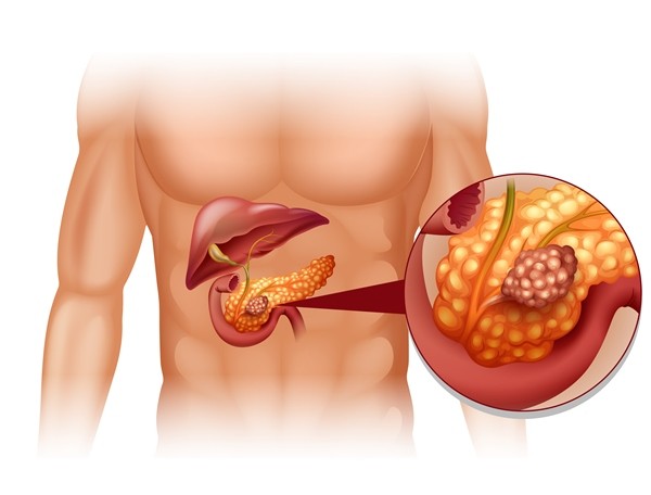 Pancreatitis és zsír - Vitaminok