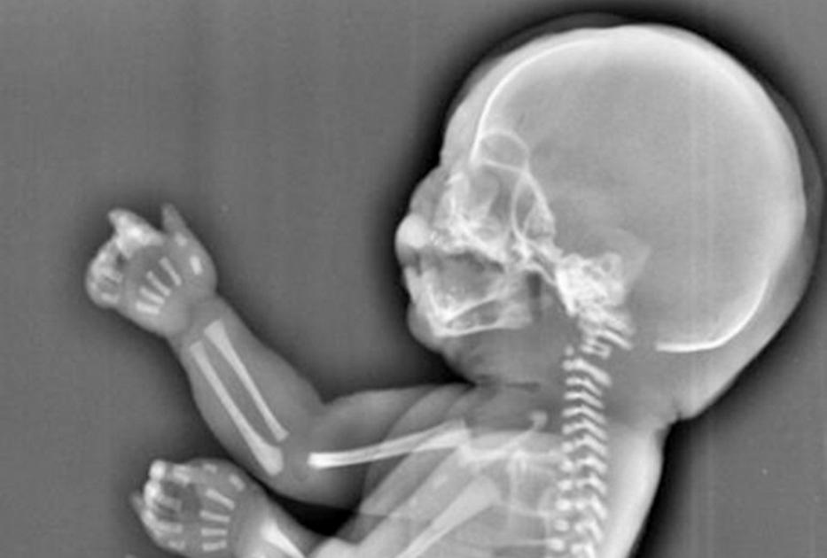 Az ultrahang sokkolta a várandós anyukát: sellőlány fejlődött a méhében! (fotó)