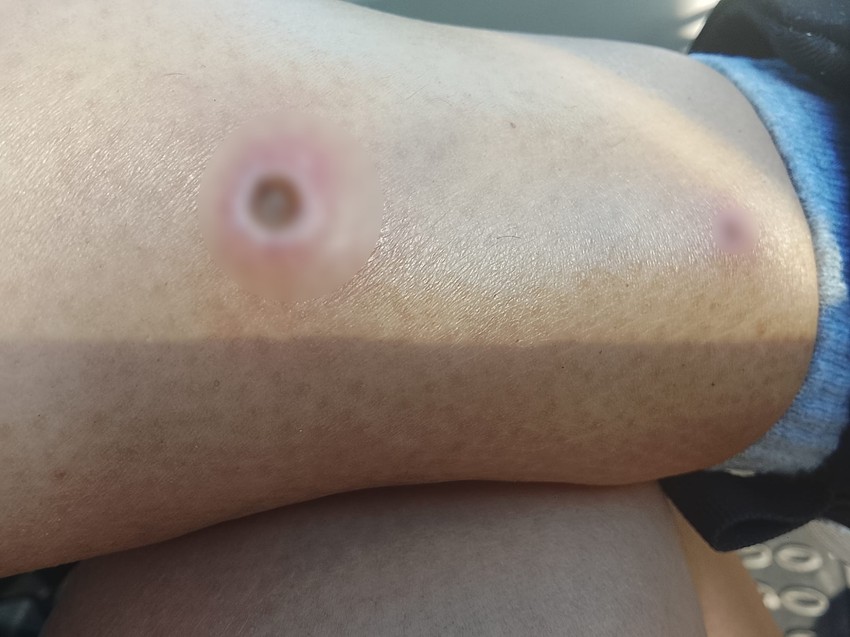 Gnojne rane od lečenja koje je Danijel dobila.