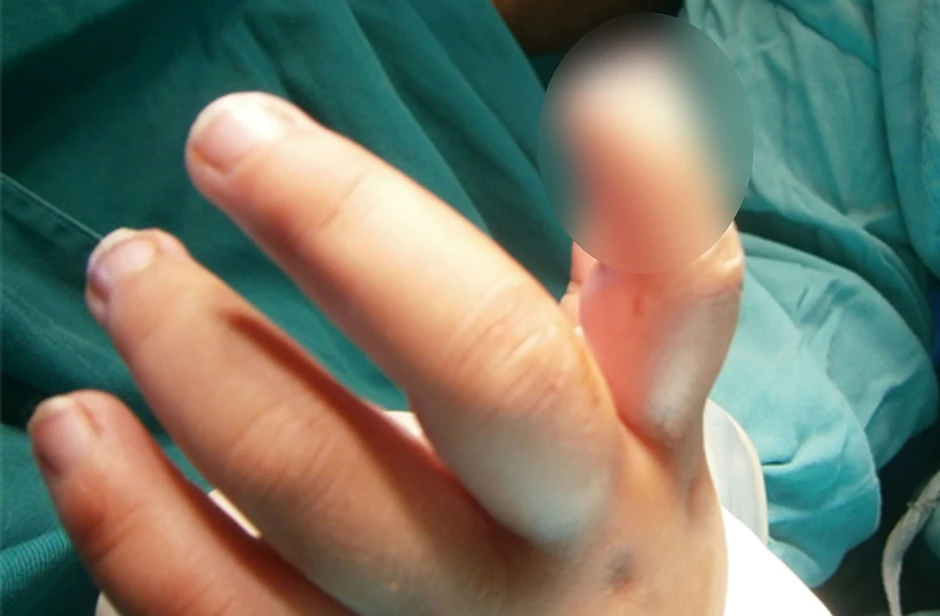 Amputacija dela prsta zbog petarde