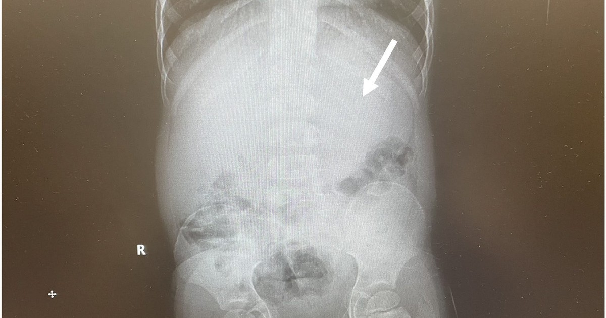 A boy who swallowed a pack of chewing gum ended up in hospital after it