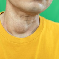 Mikor kell műteni a strúmát? Az endokrinológus válaszol