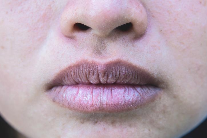 Sind die Lippen ständig spröde, an den Mundwinkeln entzündet oder weisen eine ungewöhnliche Färbung auf, kann sogar eine Krankheit dahinter stecken.