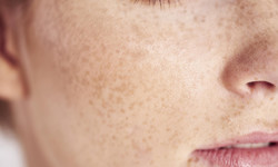 Zaburzenia barwnikowe skóry - rodzaje, objawy i leczenie