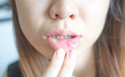 Najlepsze sposoby na afty