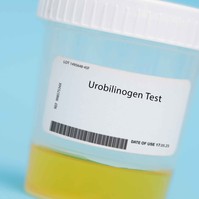 Mit jelent az urobilinogén (UBG) érték a laborleleten?