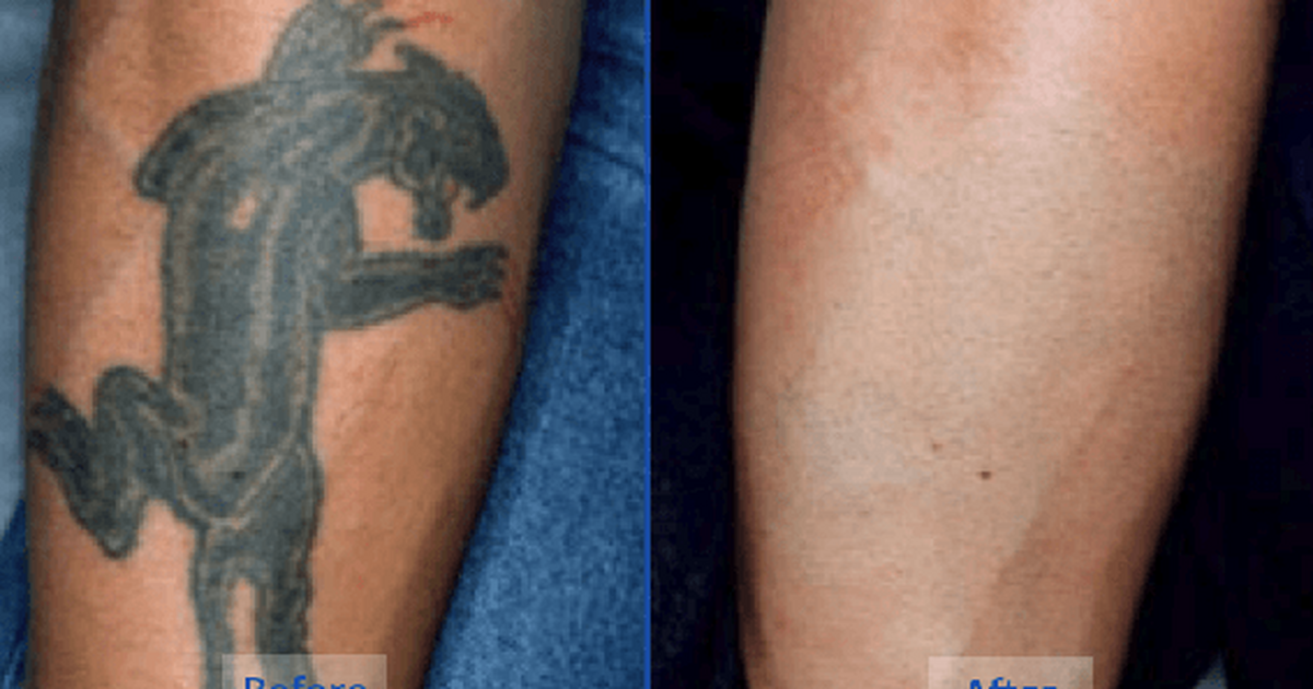 5 natural tattoo removal remedies you can try at home | Pulse Ghana