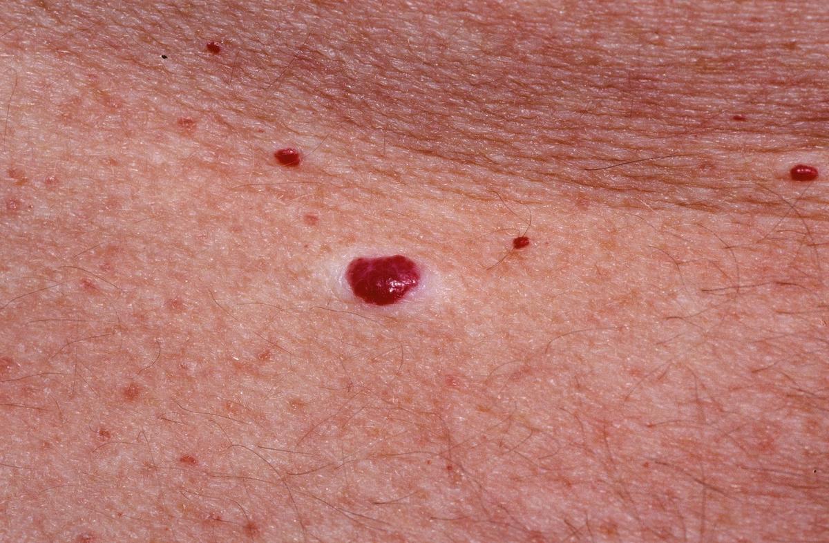 A bőrt érintő foltok okulása és kezelése piros peremmel - Allergének