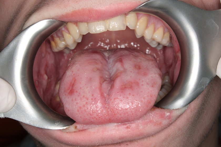 Objawy Raka Jamy Ustnej Na Co Zwracac Uwage