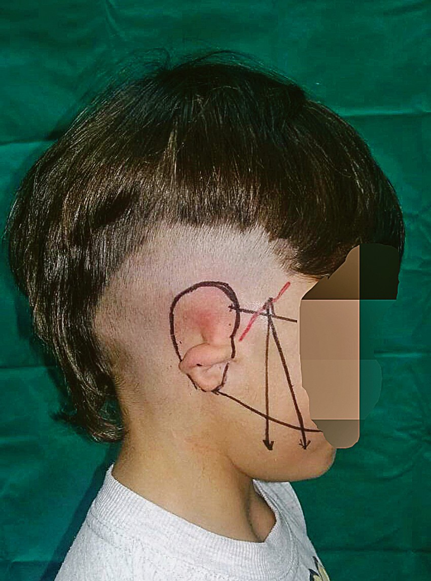 Lekar pre operacije izračunava veličinu i položaj ušne školjke