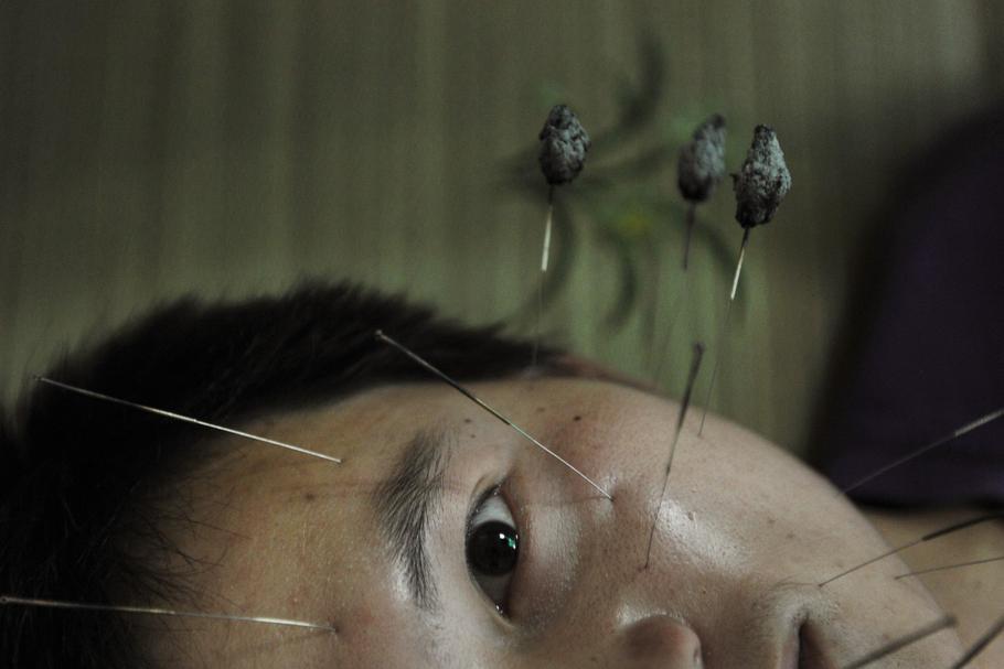 A patient suffering from facial paralysis undergoes acupuncture treatment at a traditional Chinese m