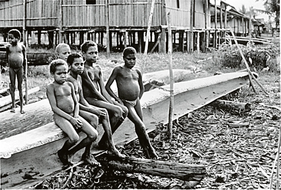 Mnoge žrtve pate od nekontrolisanih napada smeha - i umiru manje od godinu dana nakon što su prvi put pokazali simptome bolesti