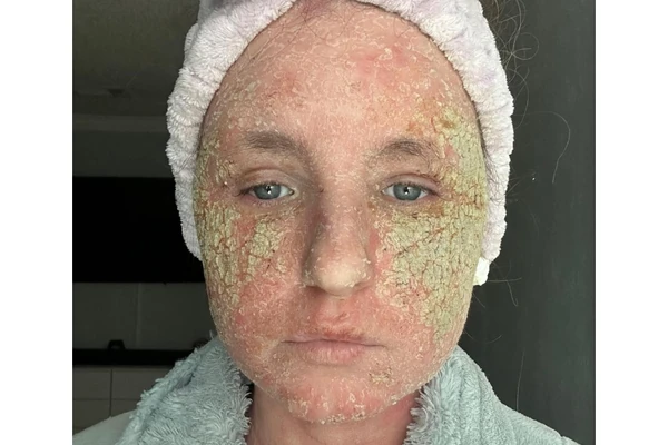 "Zbog kreme koža mi je POZELENELA I SVA JE U ŽIVIM RANAMA" Bila je lepotica, a sad se sva LJUŠTI I KOSA JOJ OTPADA
