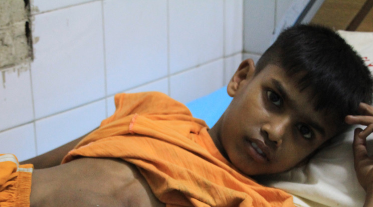 A 13 éves Mohammad Sabuz születése óta egy hatalmas tumorral küzd /Fotó: Northfoto