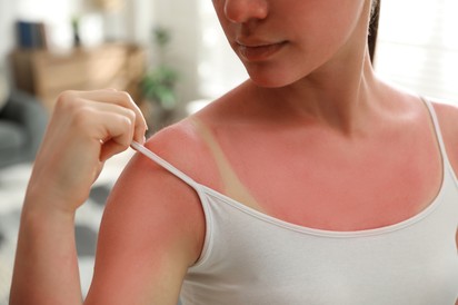 Napégés ellen: ez az alapvitamin nagy dózisban enyhítheti a tüneteket
