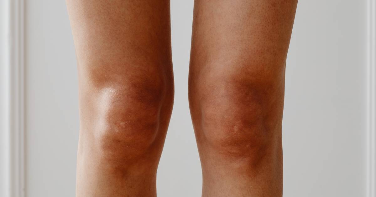 Twoje łokcie i kolana wyglądają jakby były brudne? To może być objaw  choroby | Ofeminin