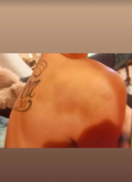 Maji telo puno modrica